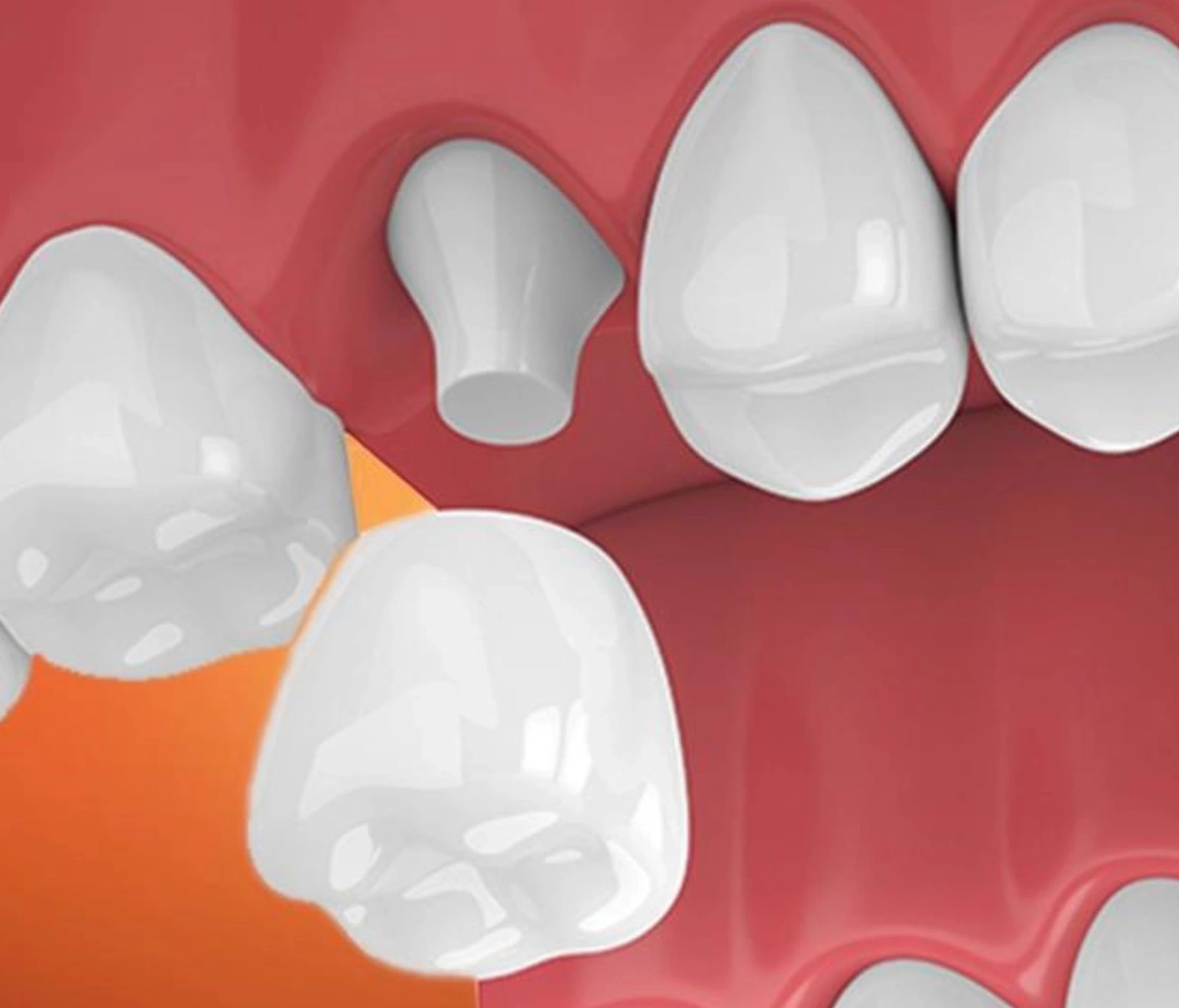 Hiểu rõ quy trình bọc răng sứ thẩm mỹ chuẩn y khoa tại Dentos